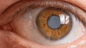 Scratched Cornea vs Pink Eye