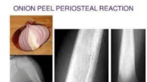 onion skin periosteal reaction with Ewing sarcoma
