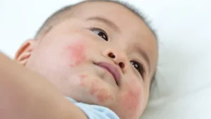 skin rashes in children