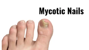Mycotic Nails