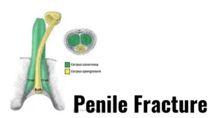Penile Fracture